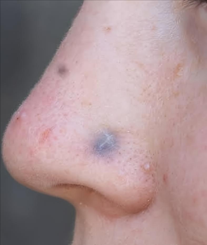 Argiria: cuando el piercing barato te tiñe la piel