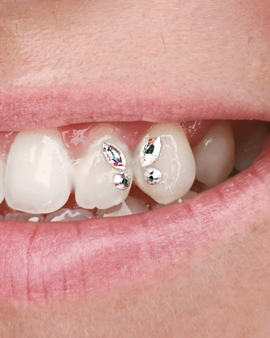 Gemas dentales colocadas en dientes frontales — técnica adhesiva no invasiva en Bendito Querer Tenerife