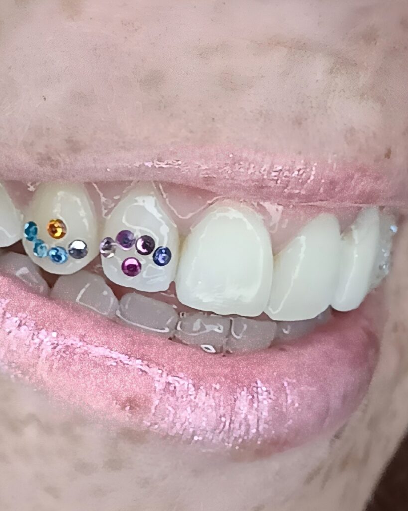 Sonrisa con gemas dentales Swarovski en colores — colocación segura sin dañar el esmalte en Bendito Querer Tenerife