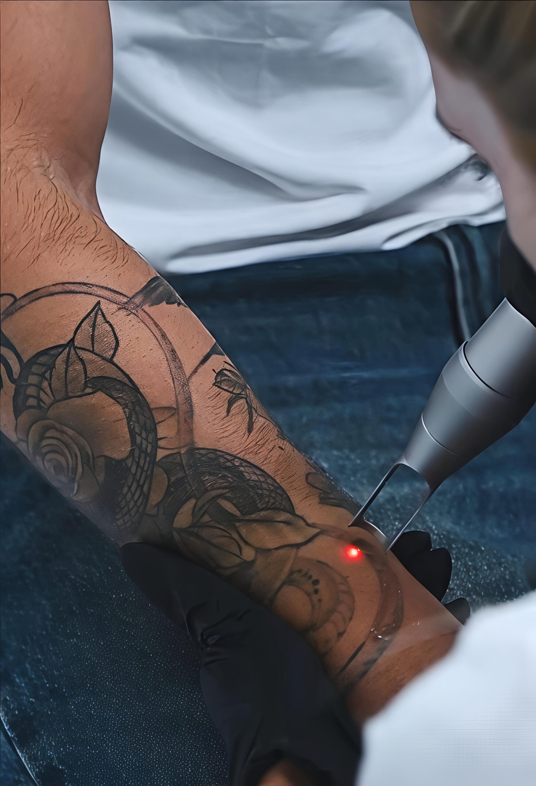 Eliminación láser · número real de sesiones según tipo de tatuaje