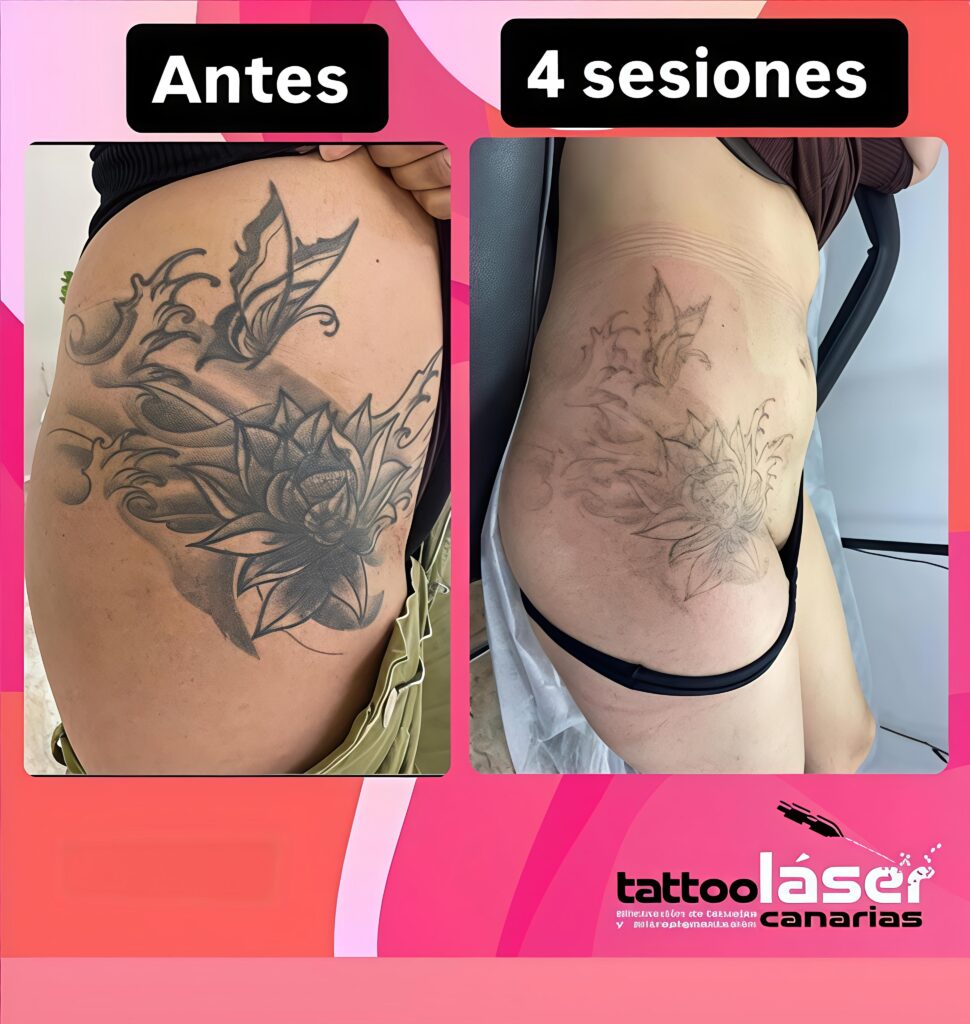 Eliminación láser de tatuajes en La Laguna · qué esperar realmente