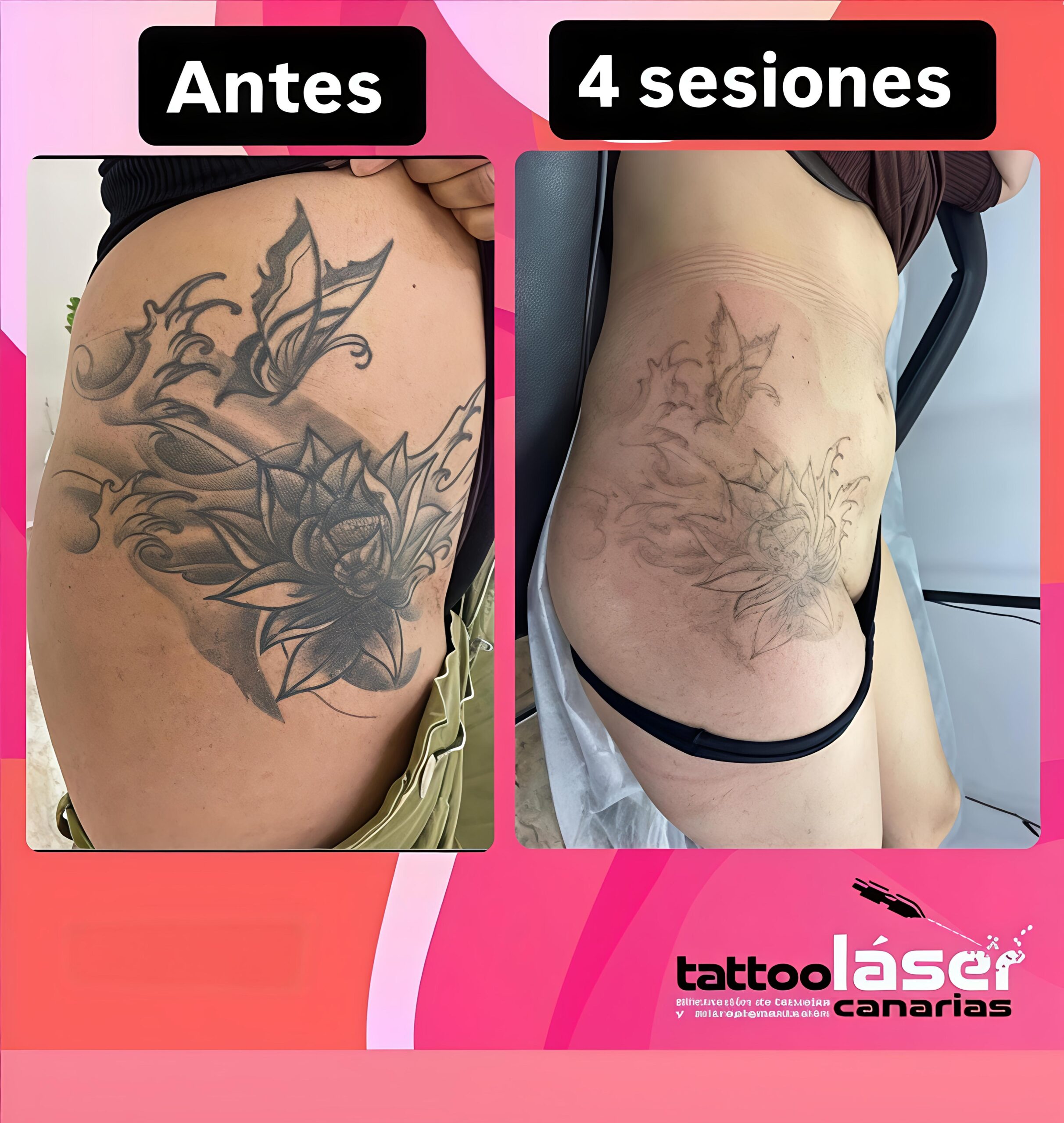 Eliminación láser de tatuajes en La Laguna · qué esperar realmente