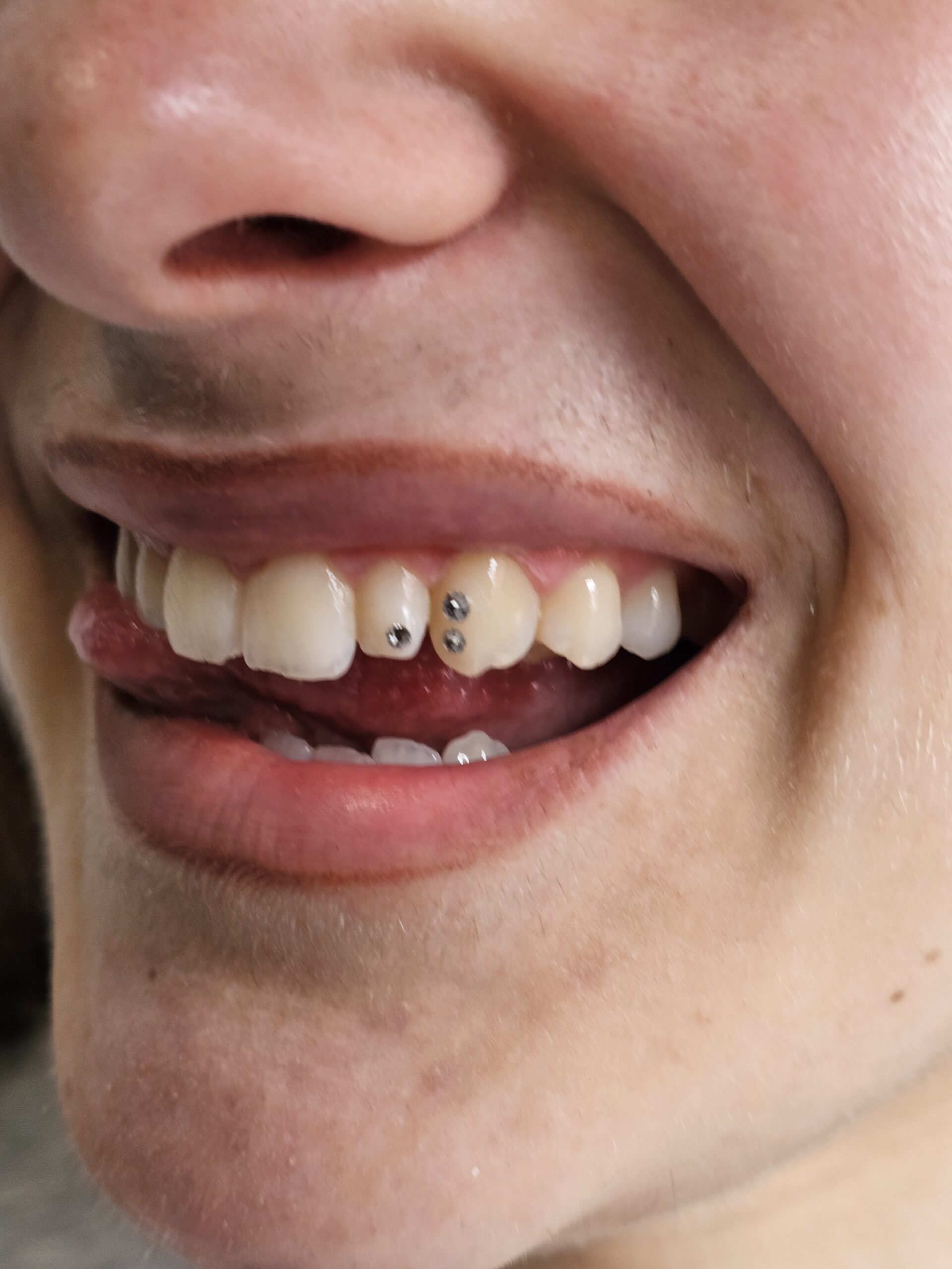 Gemas dentales · materiales, duración real y retirada sin daños