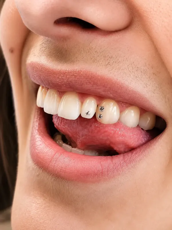 Gemas dentales